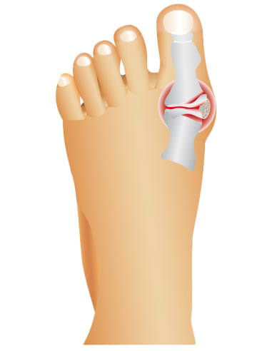 Wellys Régulateur d'orteil de nuit Paire